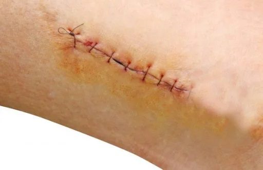 chăm sóc vết thương khâu chỉ